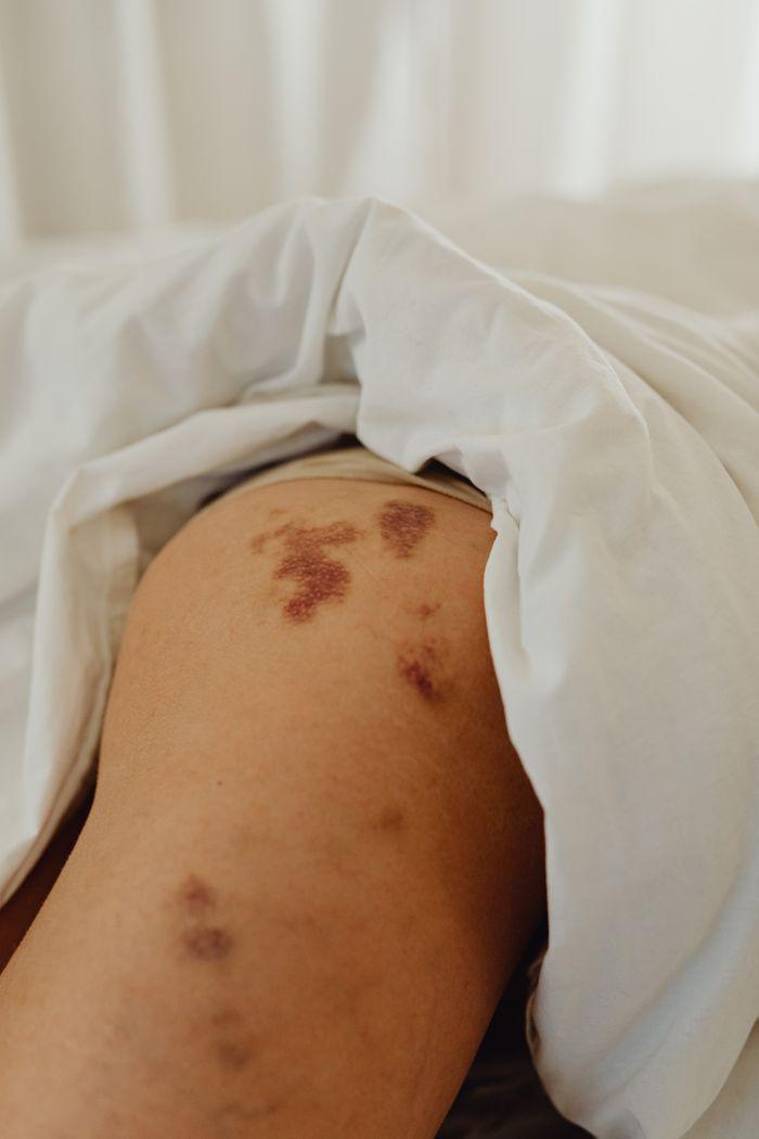 Close-up image highlighting bruises and birthmarks on a leg partially covered by a white blanket.